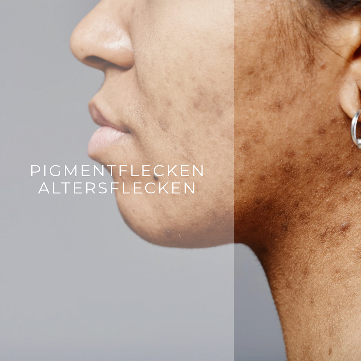 Pigmentflecken & Altersflecken